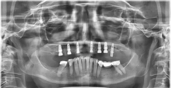 Panoramic X-ray showing full-arch implants